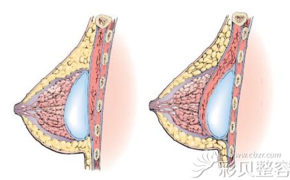 隆胸假体植入的位置