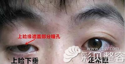 上睑下垂和正常眼睛的区别