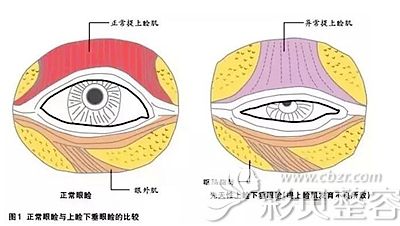 导致上睑下垂的主要原因