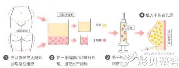 自体脂肪丰胸优势