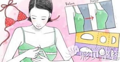 韩国艾恩整形隆胸假体选择