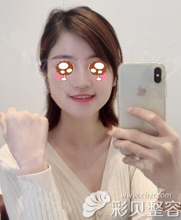 在韩国艾恩做面部吸脂术后30天