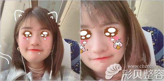 在韩国艾恩做面部吸脂术后60天