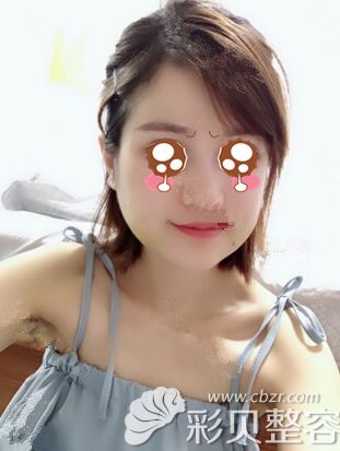 在韩国艾恩做面部吸脂术后10天