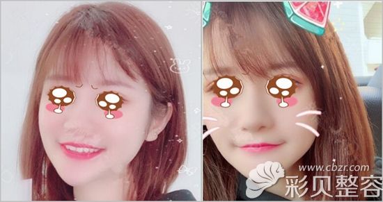 韩国艾恩面部吸脂案例