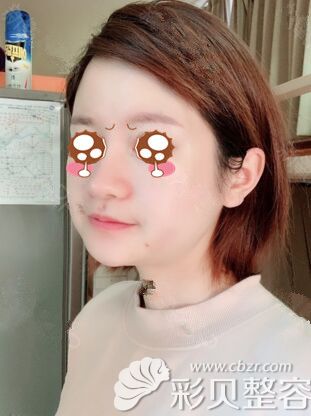 在韩国艾恩做面部吸脂术后2天