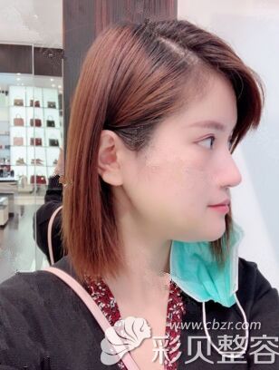 在韩国艾恩做面部吸脂术后7天