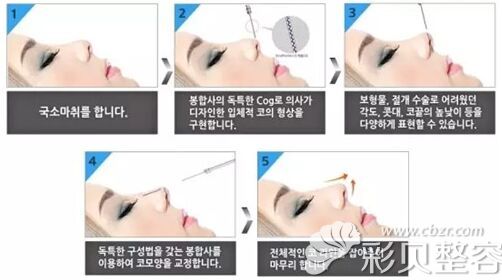 韩国艾恩整形misko隆鼻怎么样?效果能保持多久呢?谁做的好？