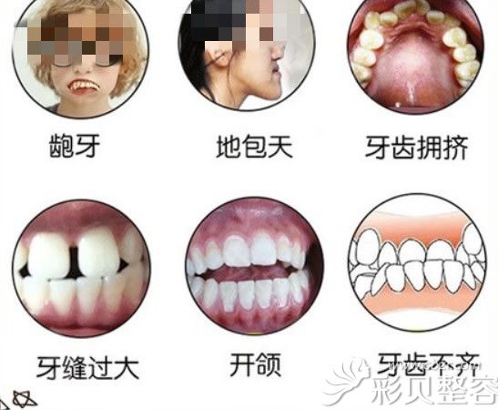 哪些牙齿需要矫正 哪些牙齿需要矫正