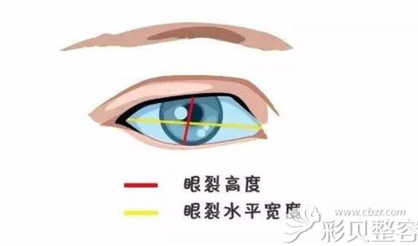 眼裂高度和宽度示意图 眼裂高度和宽度示意图
