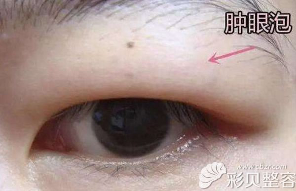 臃肿的眼睛不好看 臃肿的眼睛不好看