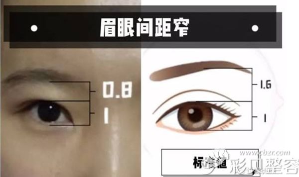 眉眼间距窄和标准值示意图 眉眼间距窄和标准值示意图