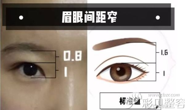眉眼间距窄和标准值示意图