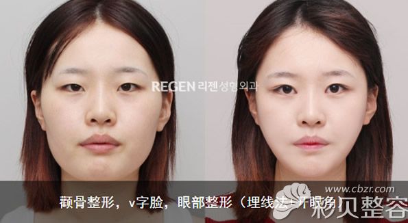 韩国丽珍吴铭埈医生颧骨整形+小V脸+埋线双眼皮和开眼角案例