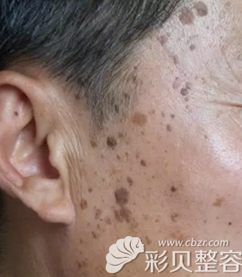 脂溢性角化病长发生于面颊两侧