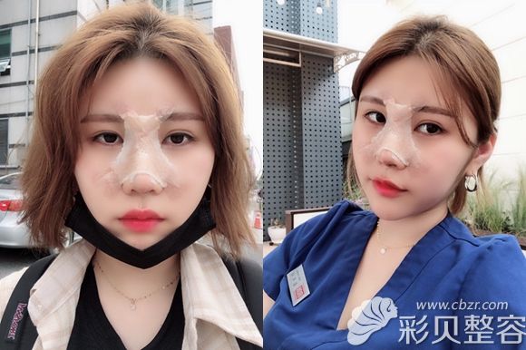 韩国艾恩整形护士做鼻综合术后