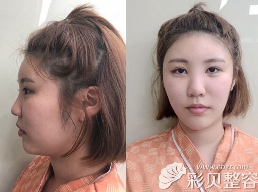 韩国做鼻综合可以考虑艾恩整形因为术后真的肿胀轻恢复