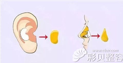 耳软骨垫鼻尖手术原理