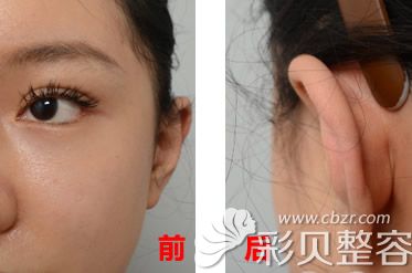贴发耳矫正前后效果对比图