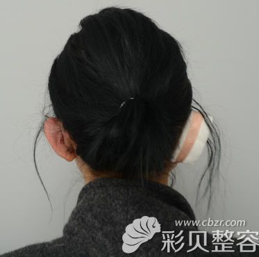 韩国普罗菲耳郑在皓矫正贴发耳第二天