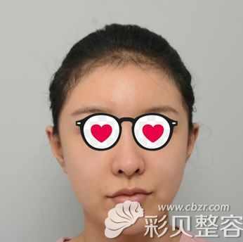 韩国普罗菲耳profile医院矫正贴发耳前