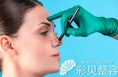 改善鼻部形态可以做隆鼻手术