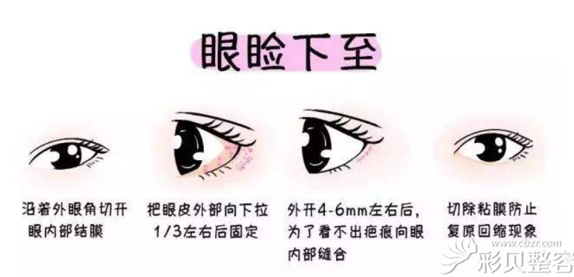 济南塑星整形邢学斌讲动漫眼的外眼角下至特色与适宜人群