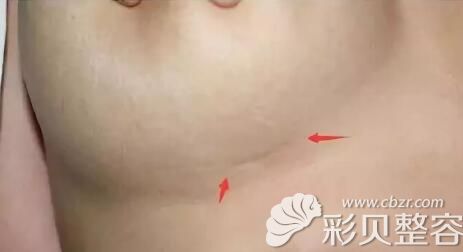 肋软骨隆鼻疤痕 肋软骨隆鼻疤痕