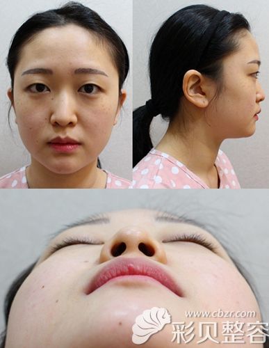 韩国艾恩综合隆鼻手术前照片