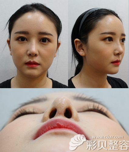 韩国艾恩综合隆鼻手术后照片