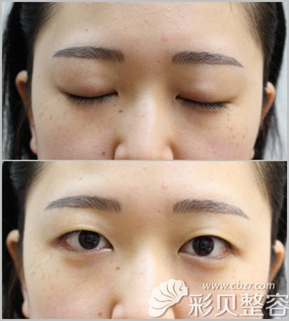 韩国艾恩双眼皮手术前照片