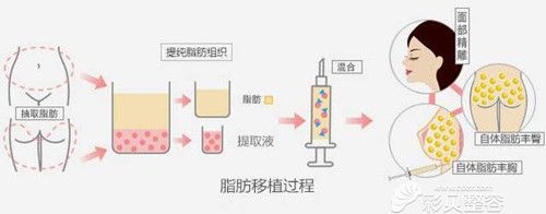 王锦医生说做自体脂肪移植手术过程 王锦医生说做自体脂肪移植手术过程