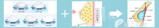 复合式丰胸原理 复合式丰胸原理