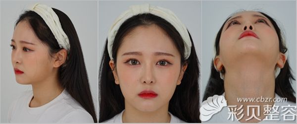 韩国艾恩眼鼻+面部填充术后效果