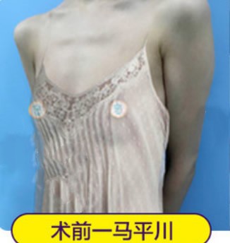 看重庆军科整形医院赵亚均医生做胸部脂肪填充15天恢复照片
