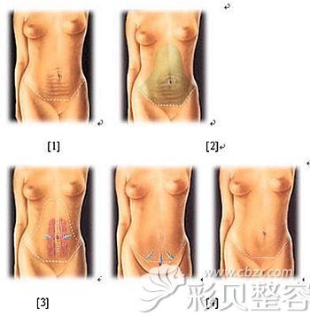 济南集美腹壁整形手术的原理