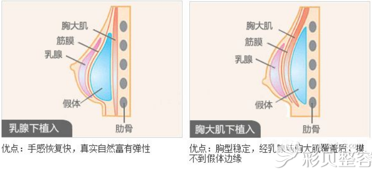 胸假体乳腺下植入与胸大肌下植入区别对比图