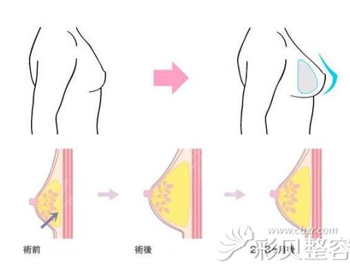 假体丰胸+自体脂肪丰胸的复合式丰胸 假体丰胸+自体脂肪丰胸的复合式丰胸