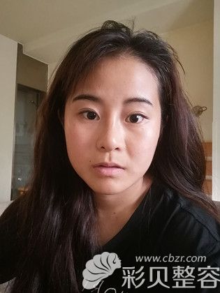 韩国艾恩轮廓手术后一年