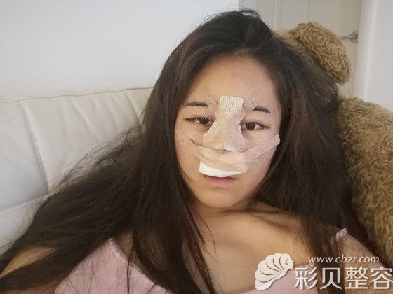 韩国艾恩眼鼻综合术后当天