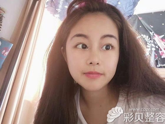 韩国艾恩眼鼻综合术后一个月