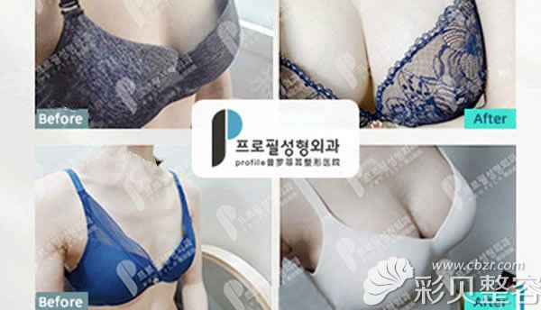 韩国profile整形蓓拉假体隆胸真人案例对比图