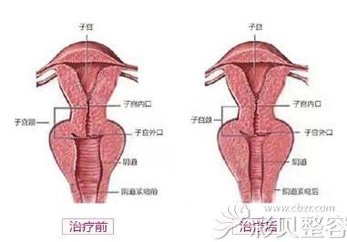 阴道紧缩术对比图