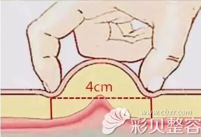 两只手指之间能达到4公分可做自体脂肪隆胸