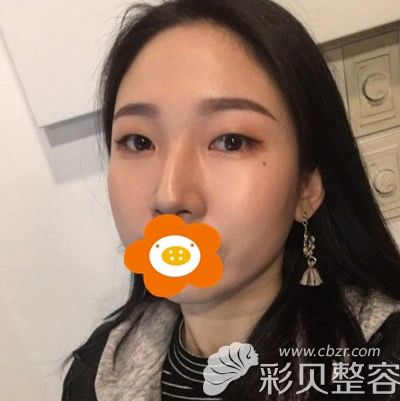 找韩国艾恩整形金承俊院长做双眼皮和鹰钩鼻矫正照片分享