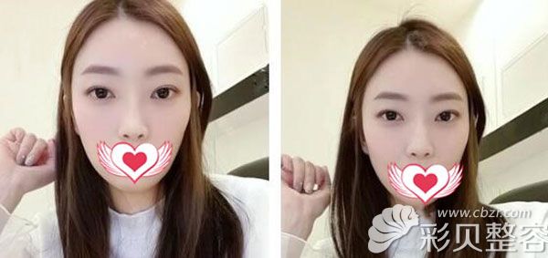 隆鼻二次修复一个月恢复的很自然