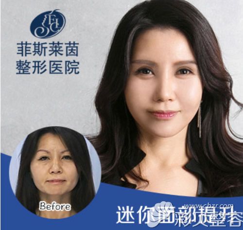 韩国菲斯莱茵faceline李泰喜面部提升效果