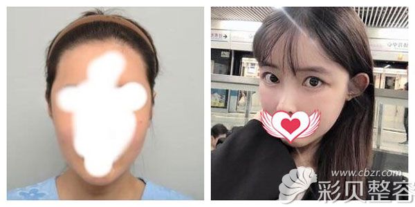 在韩国普罗菲耳整形做贴发耳矫正前后对比图