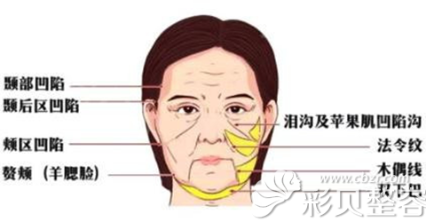 面部衰老呈现的趋势 面部衰老呈现的趋势