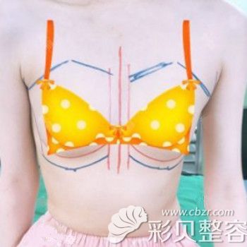在找韩国profile医院郑在皓院长做魔滴假体隆胸前胸部照片